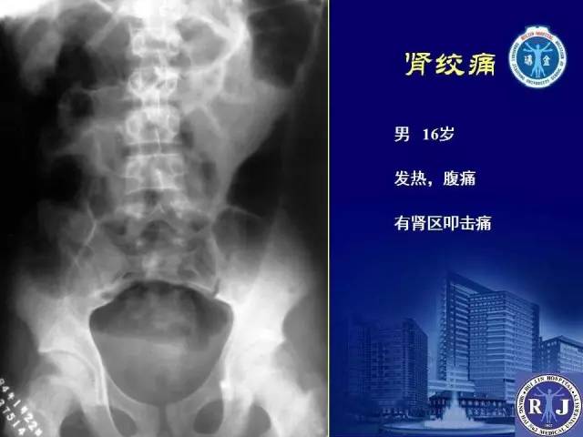 【PPT】反射性肠郁积的影像学表现