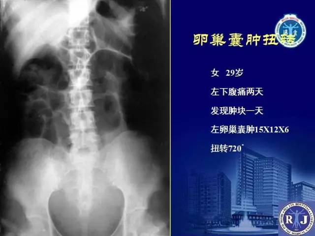 【PPT】反射性肠郁积的影像学表现