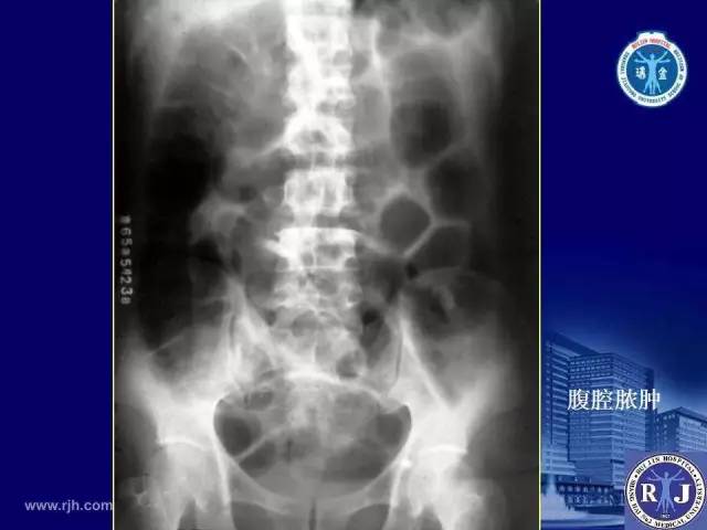 【PPT】反射性肠郁积的影像学表现