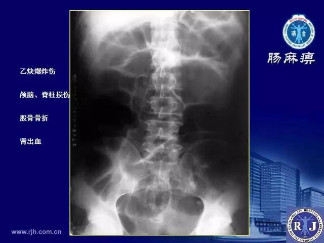 【PPT】反射性肠郁积的影像学表现