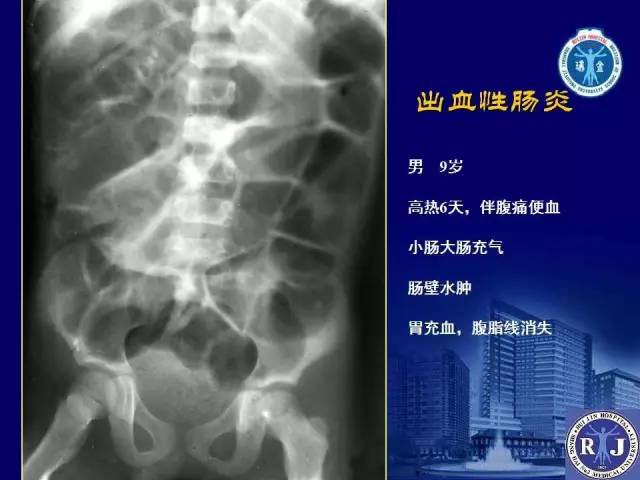 【PPT】反射性肠郁积的影像学表现