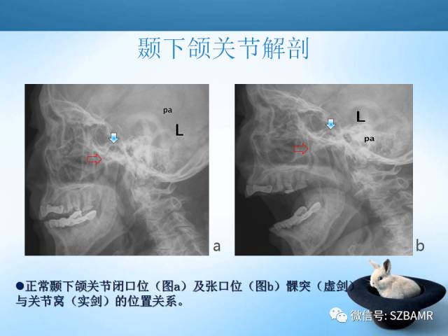 【PPT】颞下颌关节解剖及关节紊乱影像表现