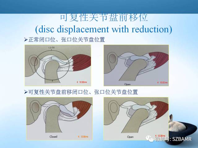 【PPT】颞下颌关节解剖及关节紊乱影像表现