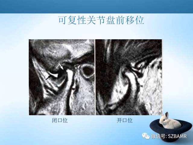 【PPT】颞下颌关节解剖及关节紊乱影像表现
