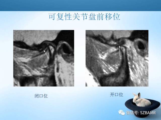 【PPT】颞下颌关节解剖及关节紊乱影像表现