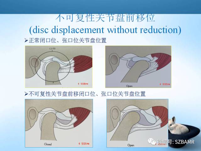 【PPT】颞下颌关节解剖及关节紊乱影像表现