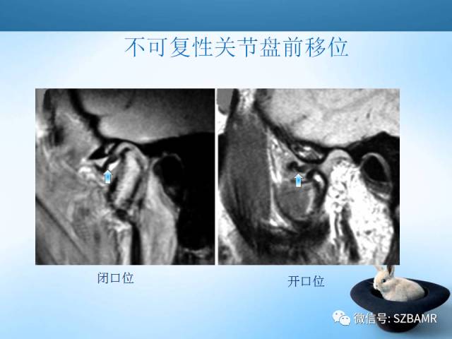 【PPT】颞下颌关节解剖及关节紊乱影像表现
