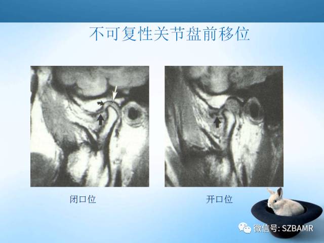 【PPT】颞下颌关节解剖及关节紊乱影像表现
