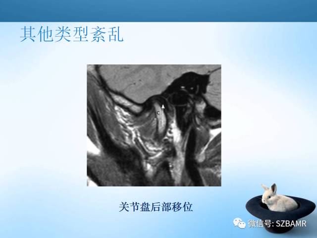 【PPT】颞下颌关节解剖及关节紊乱影像表现