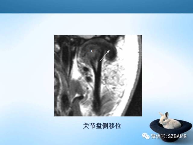 【PPT】颞下颌关节解剖及关节紊乱影像表现
