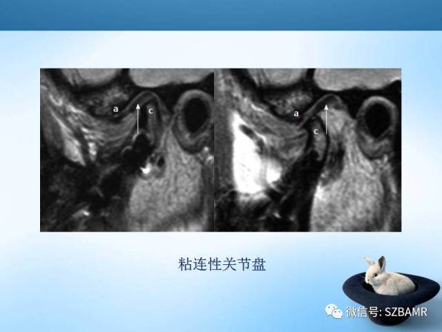 【PPT】颞下颌关节解剖及关节紊乱影像表现