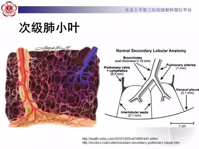 【PPT】磨玻璃密度病变的CT诊断（一）
