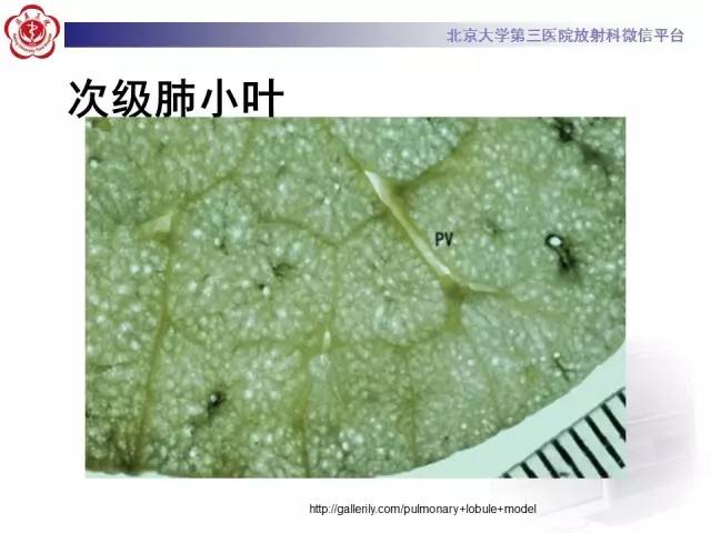 【PPT】磨玻璃密度病变的CT诊断（一）