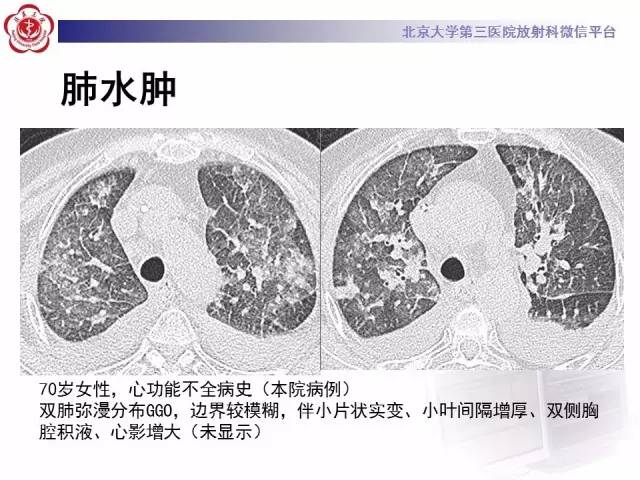 【PPT】磨玻璃密度病变的CT诊断（一）