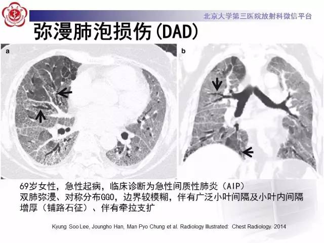 【PPT】磨玻璃密度病变的CT诊断（一）