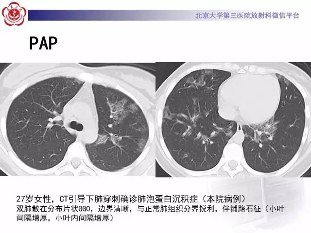 【PPT】磨玻璃密度病变的CT诊断（一）