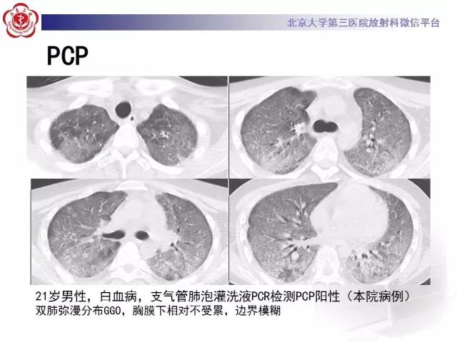 【PPT】磨玻璃密度病变的CT诊断（一）