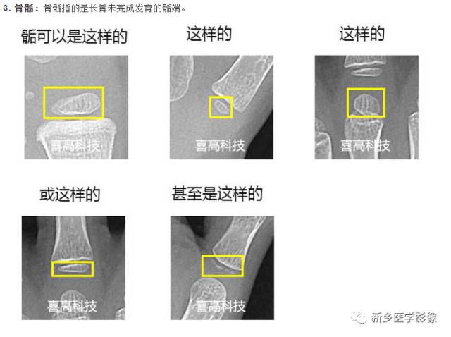 骨龄读片基础