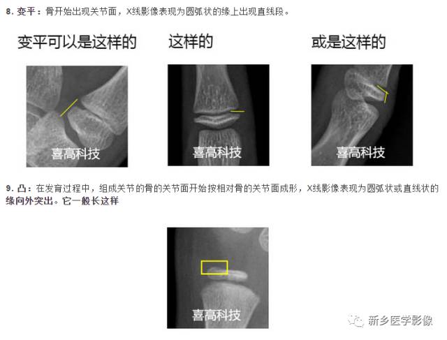 骨龄读片基础