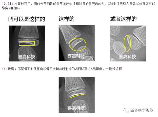 骨龄读片基础