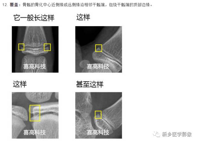 骨龄读片基础
