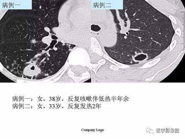 【PPT】肺球形结核的诊断——与周围型肺癌的鉴别
