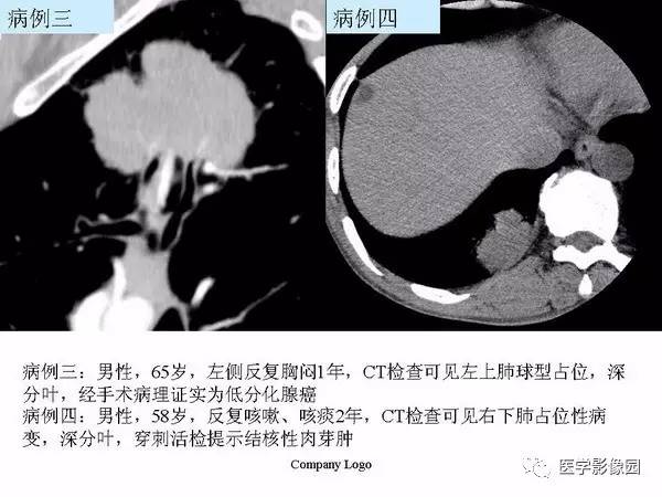 【PPT】肺球形结核的诊断——与周围型肺癌的鉴别