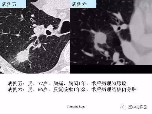 【PPT】肺球形结核的诊断——与周围型肺癌的鉴别