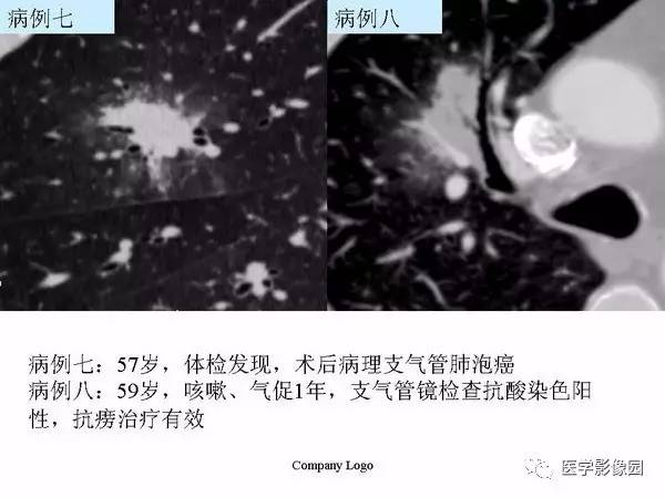 【PPT】肺球形结核的诊断——与周围型肺癌的鉴别