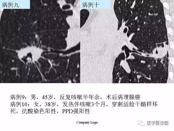 【PPT】肺球形结核的诊断——与周围型肺癌的鉴别