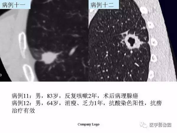 【PPT】肺球形结核的诊断——与周围型肺癌的鉴别