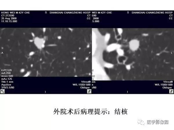【PPT】肺球形结核的诊断——与周围型肺癌的鉴别