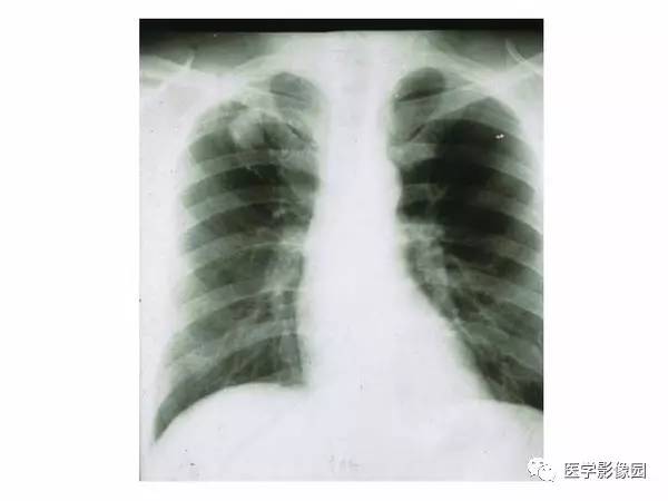 【PPT】肺球形结核的诊断——与周围型肺癌的鉴别