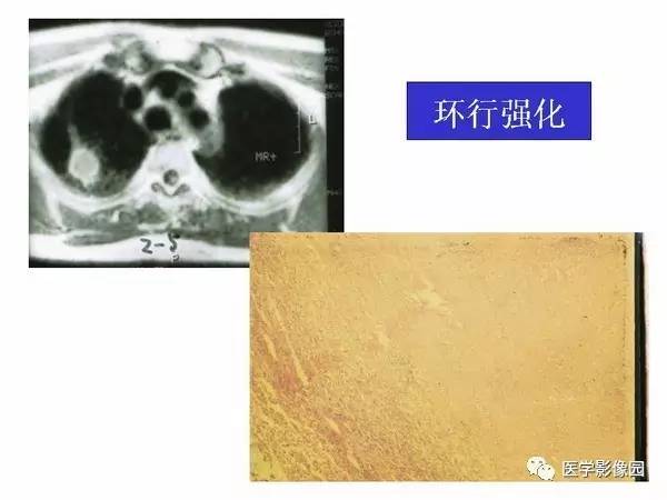 【PPT】肺球形结核的诊断——与周围型肺癌的鉴别