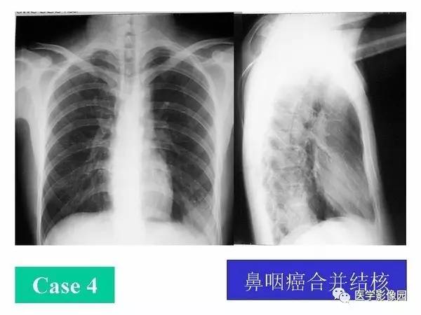 【PPT】肺球形结核的诊断——与周围型肺癌的鉴别
