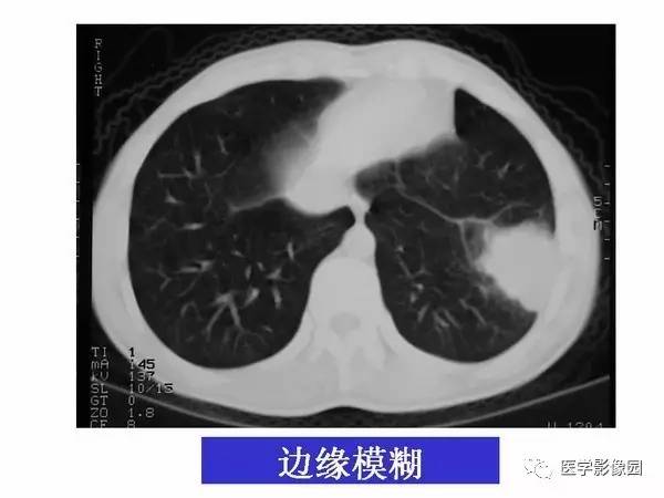 【PPT】肺球形结核的诊断——与周围型肺癌的鉴别