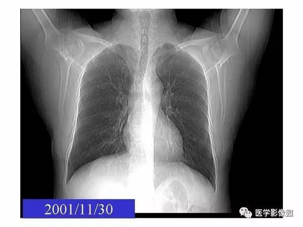 【PPT】肺球形结核的诊断——与周围型肺癌的鉴别