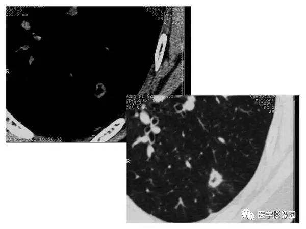 【PPT】肺球形结核的诊断——与周围型肺癌的鉴别