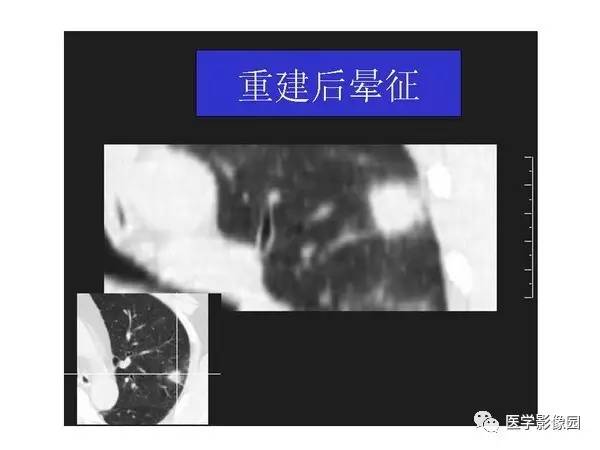 【PPT】肺球形结核的诊断——与周围型肺癌的鉴别