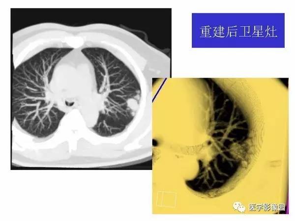 【PPT】肺球形结核的诊断——与周围型肺癌的鉴别