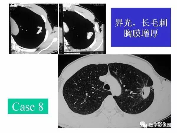 【PPT】肺球形结核的诊断——与周围型肺癌的鉴别