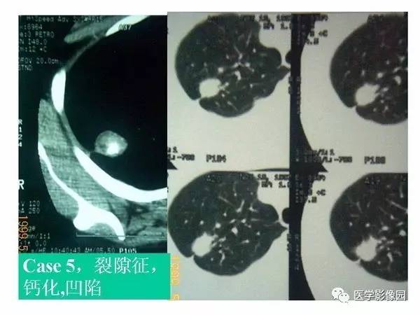 【PPT】肺球形结核的诊断——与周围型肺癌的鉴别