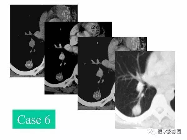 【PPT】肺球形结核的诊断——与周围型肺癌的鉴别