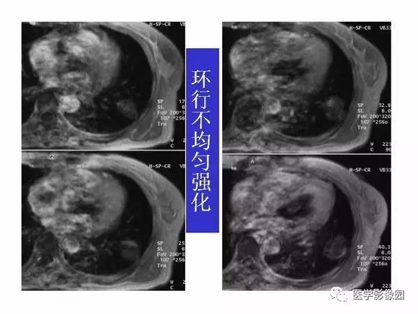 【PPT】肺球形结核的诊断——与周围型肺癌的鉴别