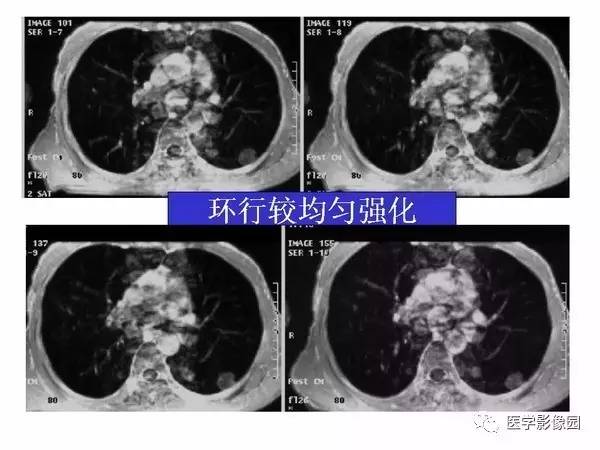 【PPT】肺球形结核的诊断——与周围型肺癌的鉴别