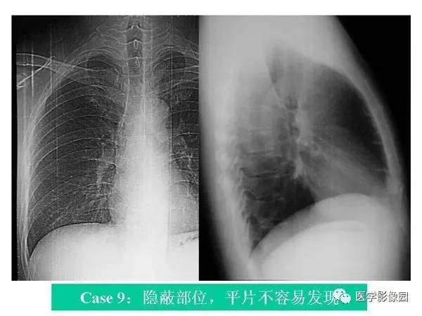 【PPT】肺球形结核的诊断——与周围型肺癌的鉴别