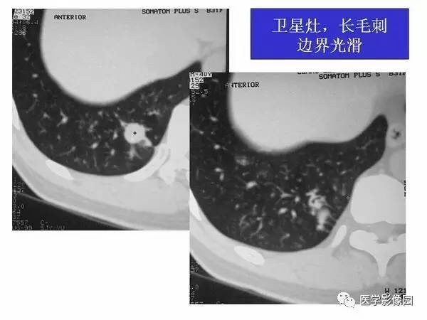 【PPT】肺球形结核的诊断——与周围型肺癌的鉴别