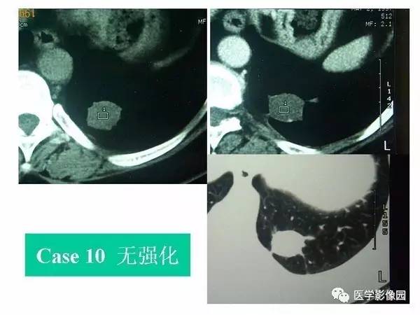 【PPT】肺球形结核的诊断——与周围型肺癌的鉴别