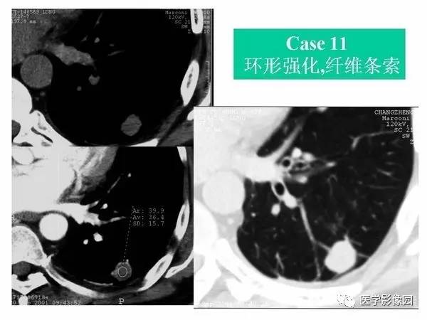【PPT】肺球形结核的诊断——与周围型肺癌的鉴别