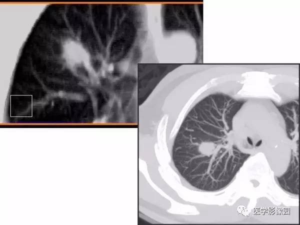【PPT】肺球形结核的诊断——与周围型肺癌的鉴别
